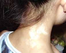 武汉女性颈部患白癜风危害有哪些？
