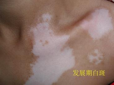 武汉环亚徐慧珍主任提醒:白斑春季易复发,寒假入院强化防扩散